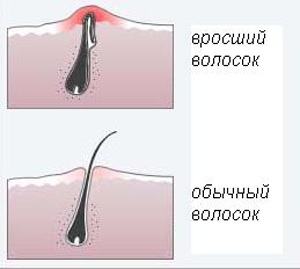 Врастание волос после эпиляции
